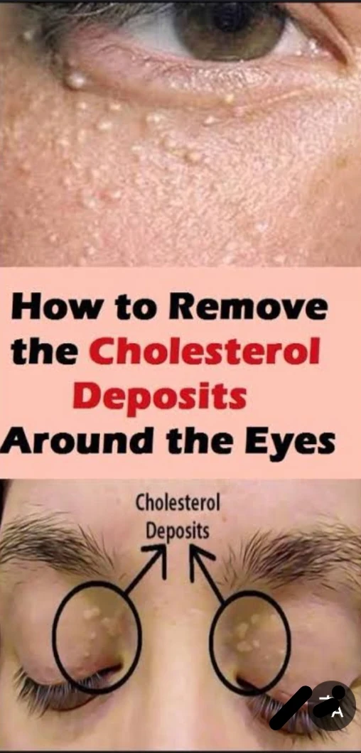 image about ماهي اللويحات الصفراء وماهي اسبابها وطرق علاجها