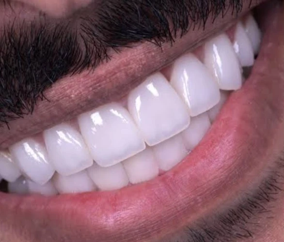 image about السر الخفي وراء أسنان بلا تسوُّس وما هو اللُّعاب المُدمر