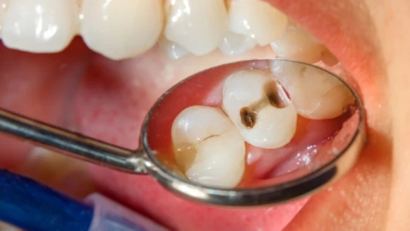 image about السر الخفي وراء أسنان بلا تسوُّس وما هو اللُّعاب المُدمر