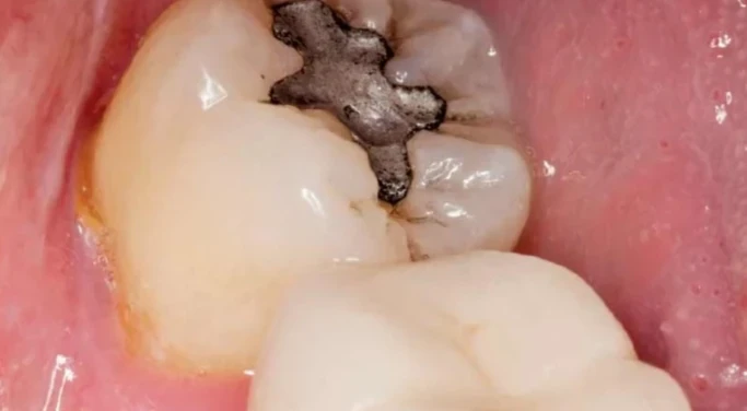 image about السر الخفي وراء أسنان بلا تسوُّس وما هو اللُّعاب المُدمر