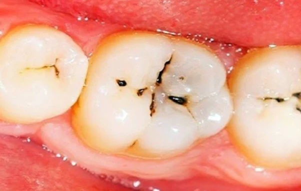 image about السر الخفي وراء أسنان بلا تسوُّس وما هو اللُّعاب المُدمر