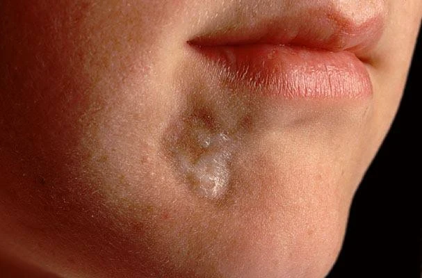 image about المرض الذى حير الاطباء