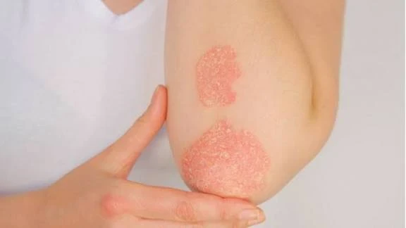 image about المرض الذى حير الاطباء