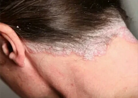 image about أضرار ومخاطر صبغات الشعر ومدى ارتباطها بالسرطان