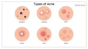 image about Acne: Causes, Symptoms, Treatment, and Prevention.