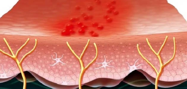 image about الحزام الناري النطاقي: ألم خفي قد يلاحقك بعد جدري الطفولة