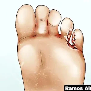 image about علاج قدم الرياضيين - خمس طرق لعلاج قدم الرياضيين