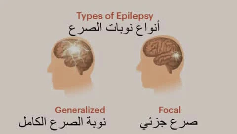 image about عندما تخرج الإشارات الكهربائية للدماغ عن السيطرة.