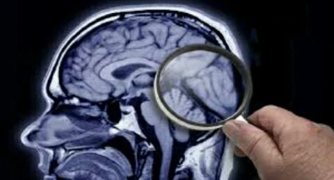 image about عندما يصبح الدماغ غير قادر على إصلاح نفسه.