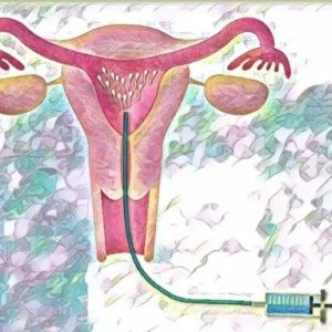 image about  التلقيح الصناعي بطريقة الغربلة 