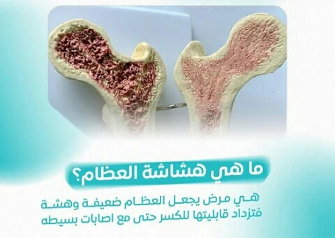 image about المرض الصامت الذي يهدد قوة الهيكل العظمي.