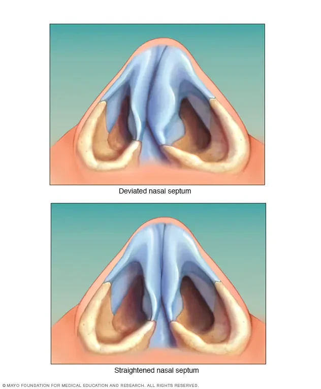image about انحراف الحاجز الأنفي