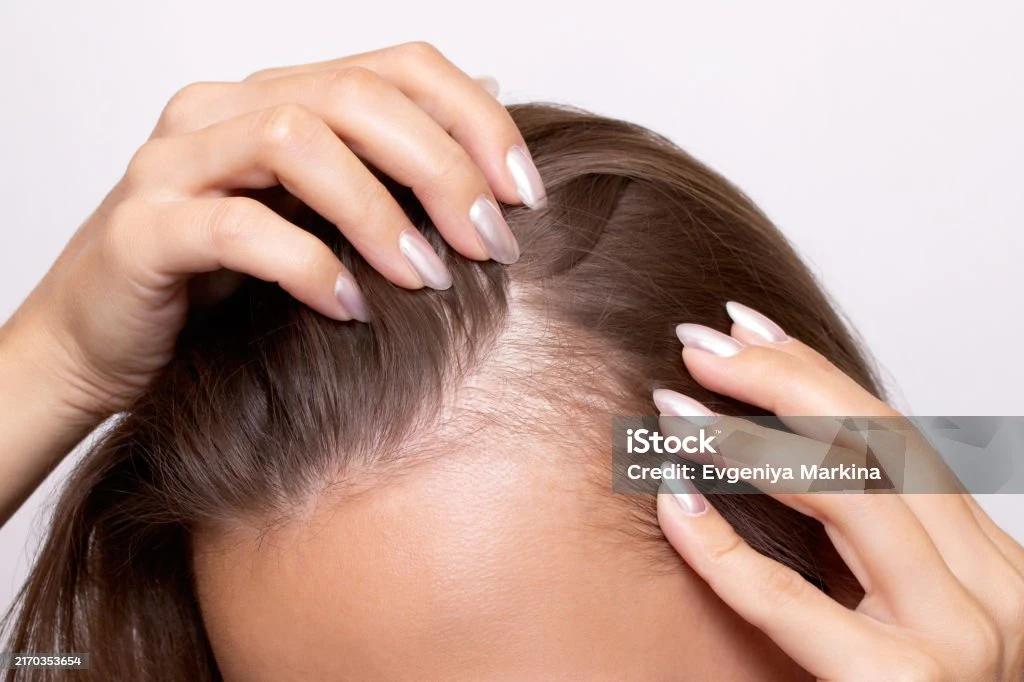 image about مشروبات شتوية شهيرة تسبّب تساقط الشعر: احذر هذه العادات اليومية التي تضعف جذور شعرك