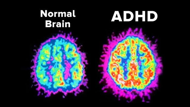 image about ADHD: كيف تعرف إن عندك الاضطراب؟ وهل يختفي أم يستمر طول العمر؟