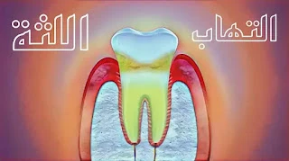 image about 17 طريقة طبيعية لعلاج التهاب اللثة لم تكن تعرفها