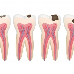 image about كيف يتم علاج تسوس الأسنان؟