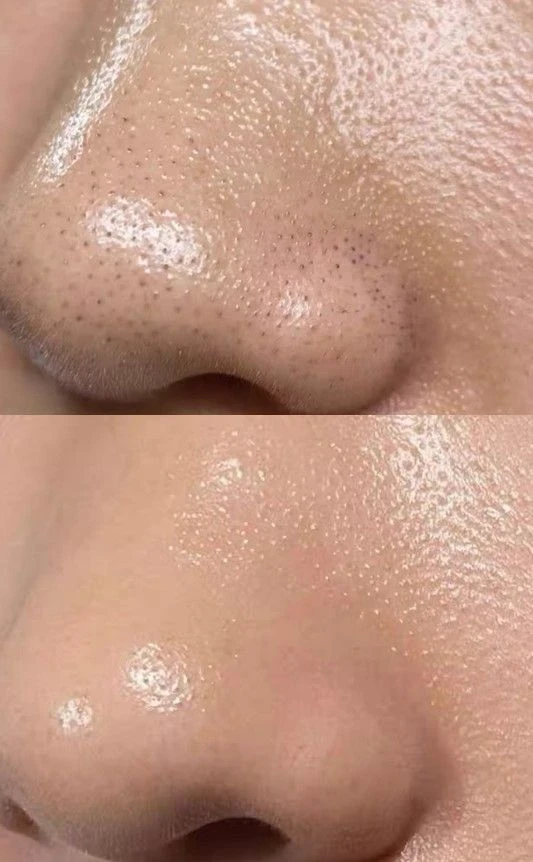 image about ✔️ إزالة الرؤوس السوداء نهائيًا في البيت: طرق فعالة وآمنة لبشرة صافية بدون تكلفة