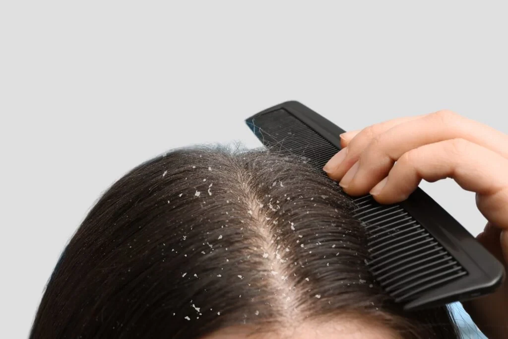 image about وداعاً للقشرة والزيوت المزعجة: الدليل النهائي لتنظيف الفروة الدهنية وإعادة حيوية شعرك جوجل