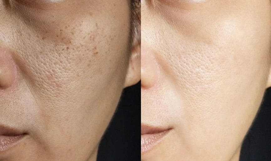 image about كريم لتفتيح البشرة السمراء في اسبوع.. مهما كان السواد من سنين مش هتصدقى بياضك