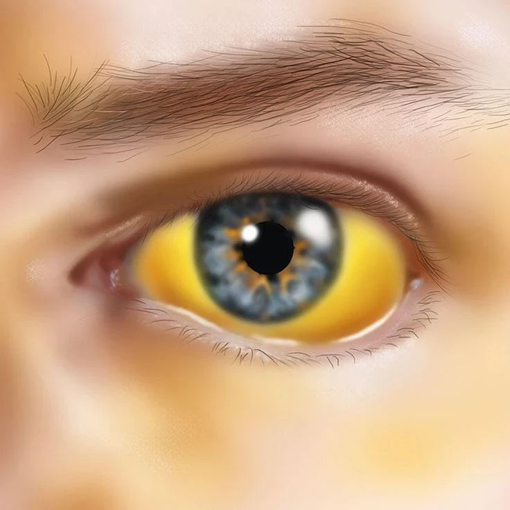 image about الصفراء ( Jaundice): أسبابها وطرق علاجها الصحيحة