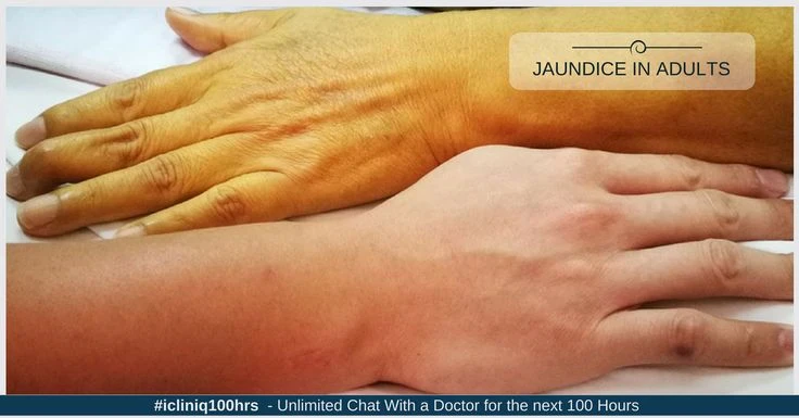 image about الصفراء ( Jaundice): أسبابها وطرق علاجها الصحيحة
