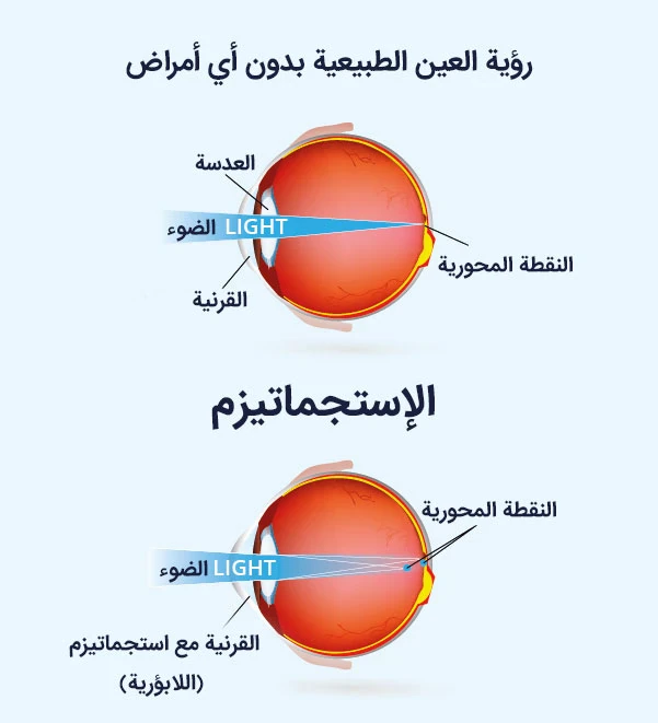 image about عبوب الابصار وأشهر طرق علاجها 