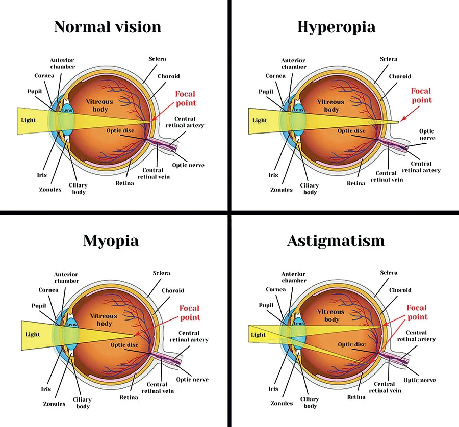 image about عبوب الابصار وأشهر طرق علاجها 