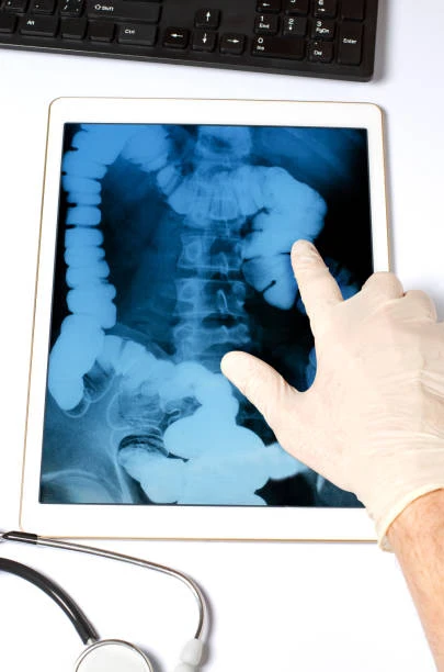 image about 🌀 القولون العصبي: الأسباب، الأعراض، وطرق العلاج الفعّالة