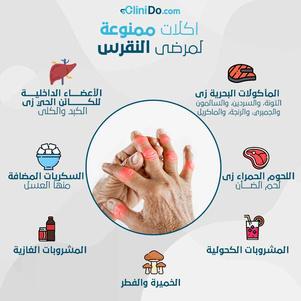 image about النقرس: لماذا يصيبك فجأة؟ وكيف تعالجه قبل أن يتفاقم