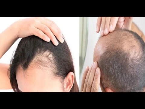 image about تساقط الشعر: كيف يختلف المسار بين النساء والشباب