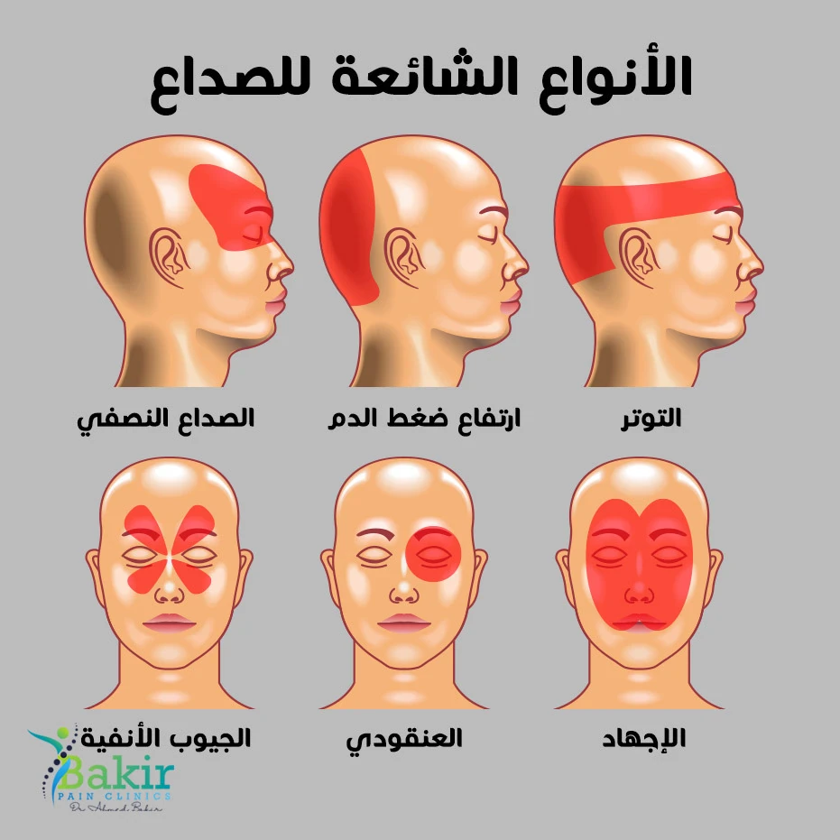 image about ليس صداعًا عاديًا… هذه العلامات تكشف أنك تعاني من الصداع النصفي!