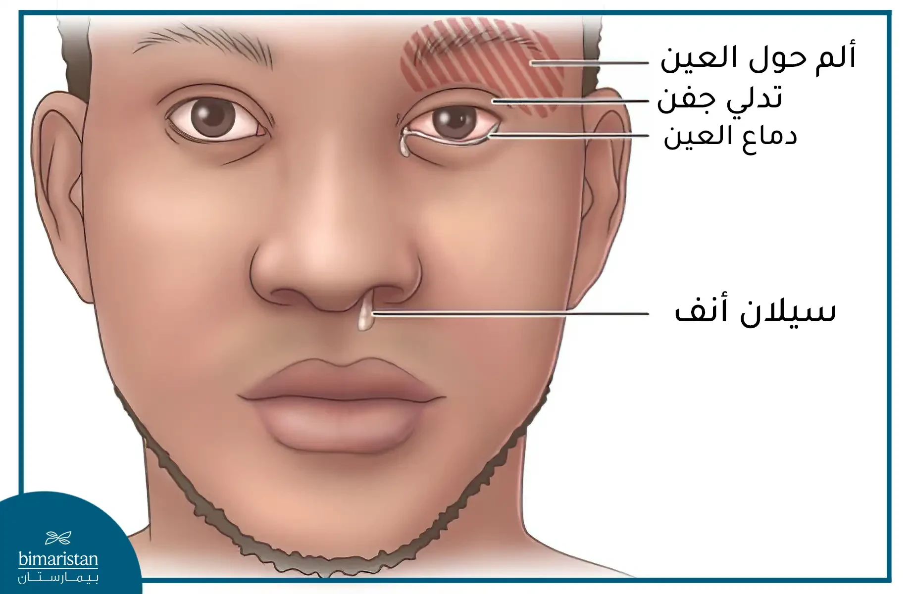 image about الصداع العنقودي: أسوأ ألم قد يضرب رأسك فجأة ويجعلك عاجزًا تمامًا