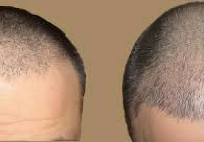 زراعة الشعر وكيف تتم هذه العملية؟