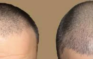 زراعة الشعر وكيف تتم هذه العملية؟