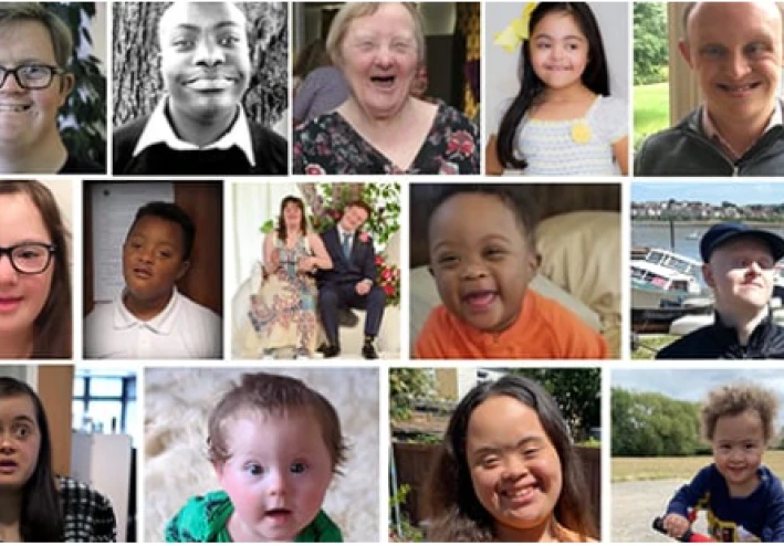 ماذا تعرف عن متلازمة داون؟ تعرف على الأسباب والأعراض والأنواع