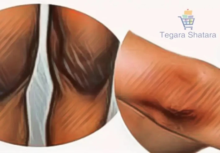 كيف تتخلصين من اسمرار الكوعين و الركب