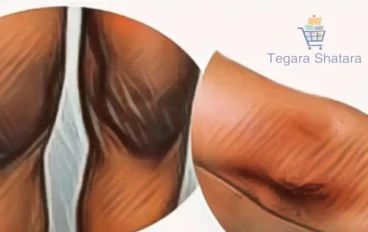 كيف تتخلصين من اسمرار الكوعين و الركب