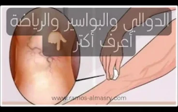 كيف يمارس الشخص المصاب بالدوالي والبواسير الرياضة