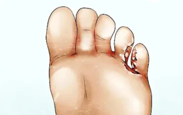 علاج قدم الرياضيين - خمس طرق لعلاج قدم الرياضيين