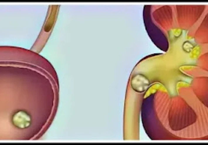 الطريقة التي ستفكك بها حصوات الكلى بمساعدة مكون واحد موجود لدينا جميعًا في المطبخ