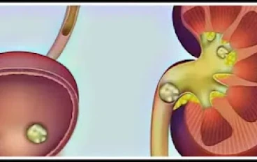 الطريقة التي ستفكك بها حصوات الكلى بمساعدة مكون واحد موجود لدينا جميعًا في المطبخ