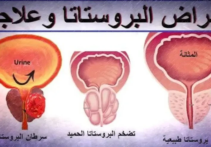 ما الأشياء الضارة بالبروستاتا وتسبب تضخمها؟