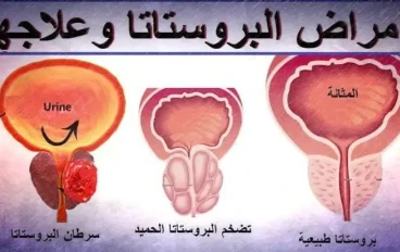 ما الأشياء الضارة بالبروستاتا وتسبب تضخمها؟