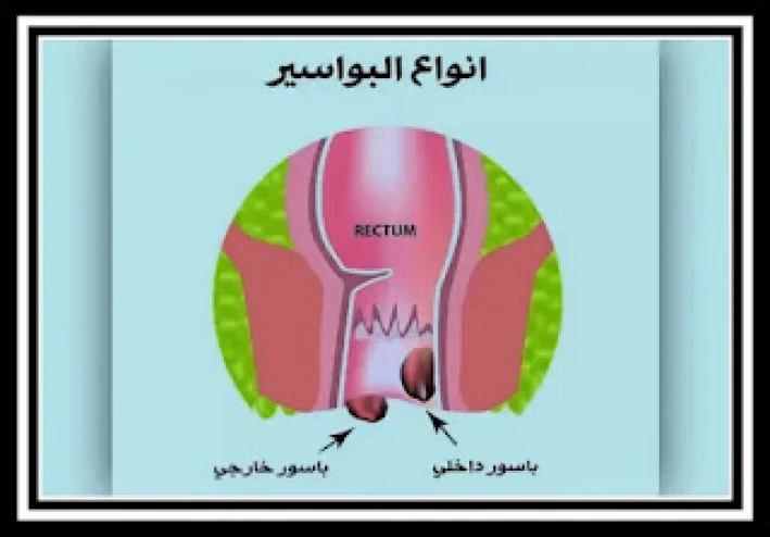 علاج البواسير بالليزر بدون جراحة