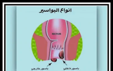 علاج البواسير بالليزر بدون جراحة