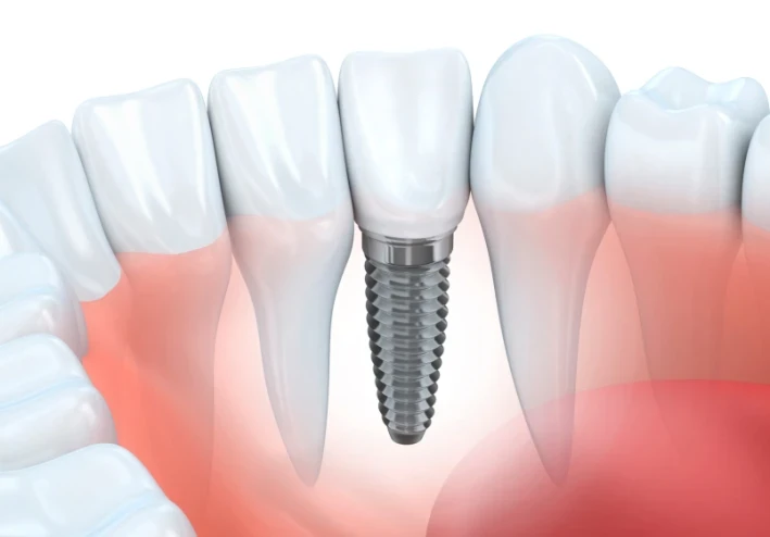 ما هي زراعة الأسنان وكيف تتم؟