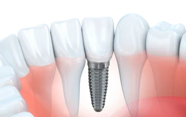 ما هي زراعة الأسنان وكيف تتم؟