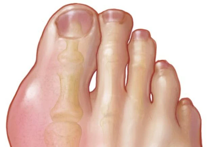 مرض النقرس (Gouty arthritis) : ما هو ؟ ، و ما هي أعراضه ؟ .