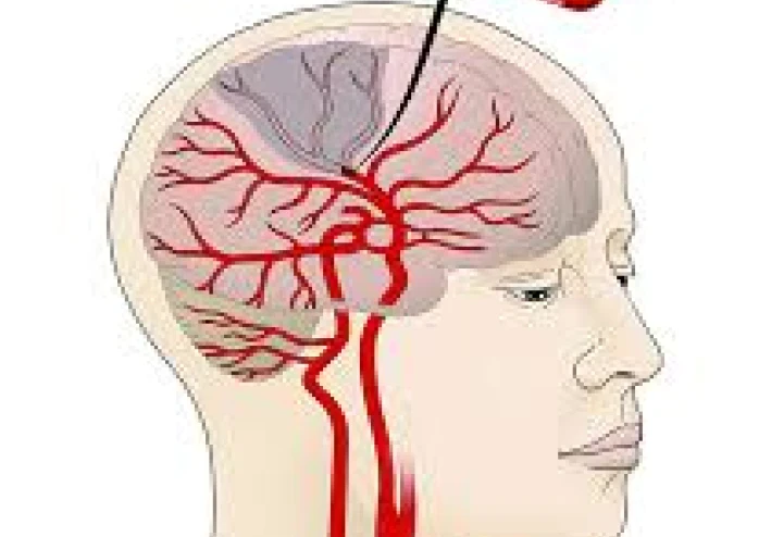 أسباب الجلطة الدماغية