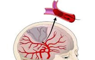 أسباب الجلطة الدماغية